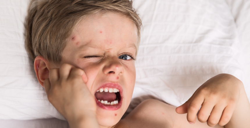 Фото - Ветрянка (ветряная оспа) у взрослых и детей