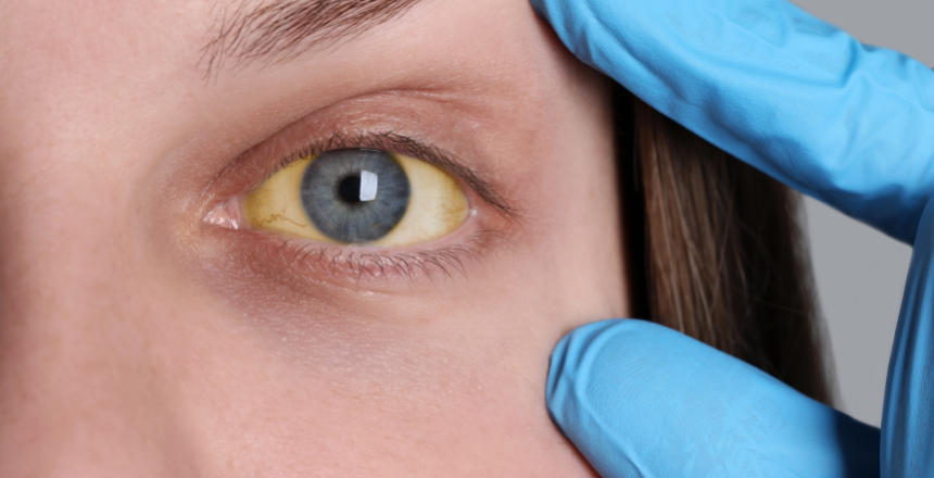 Фото - Билирубин