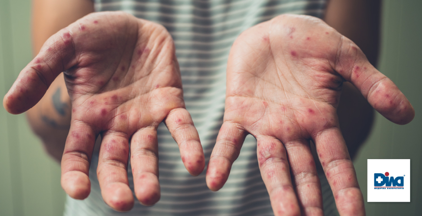 Фото - Корь возвращается: что делать?