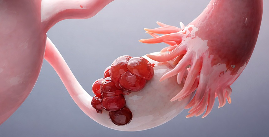 Фото - Кіста яєчника: види та як вчасно виявити патологію