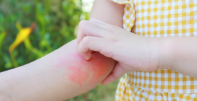 Картинка - Алергія у дітей: види, симптоми, причини та сучасний підхід до діагностики