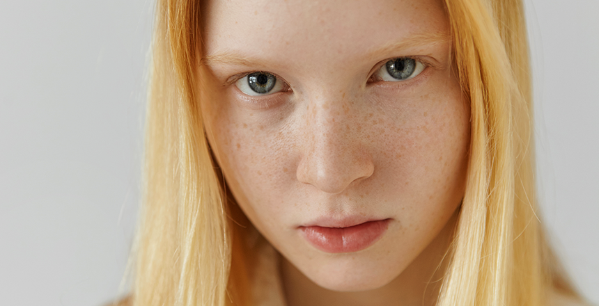 Фото - Гіперпігментація шкіри