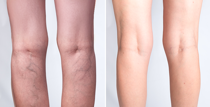 здорова нога та нога з набряком 