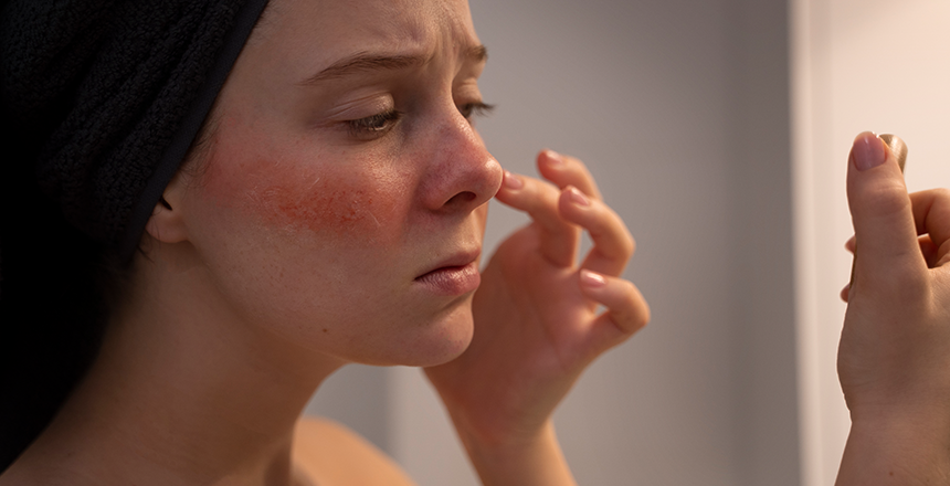 Красная волчанка