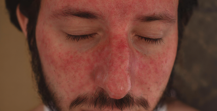 Как выглядит красная волчанка