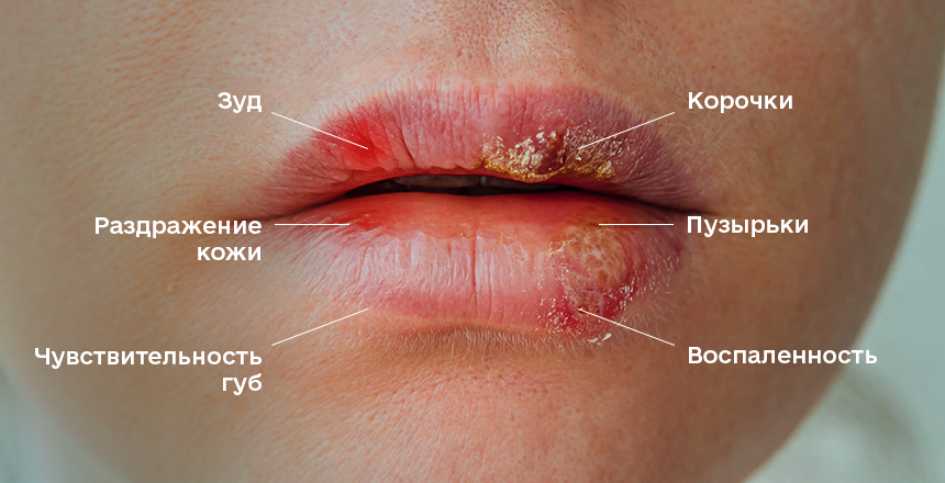 симптомы герпеса