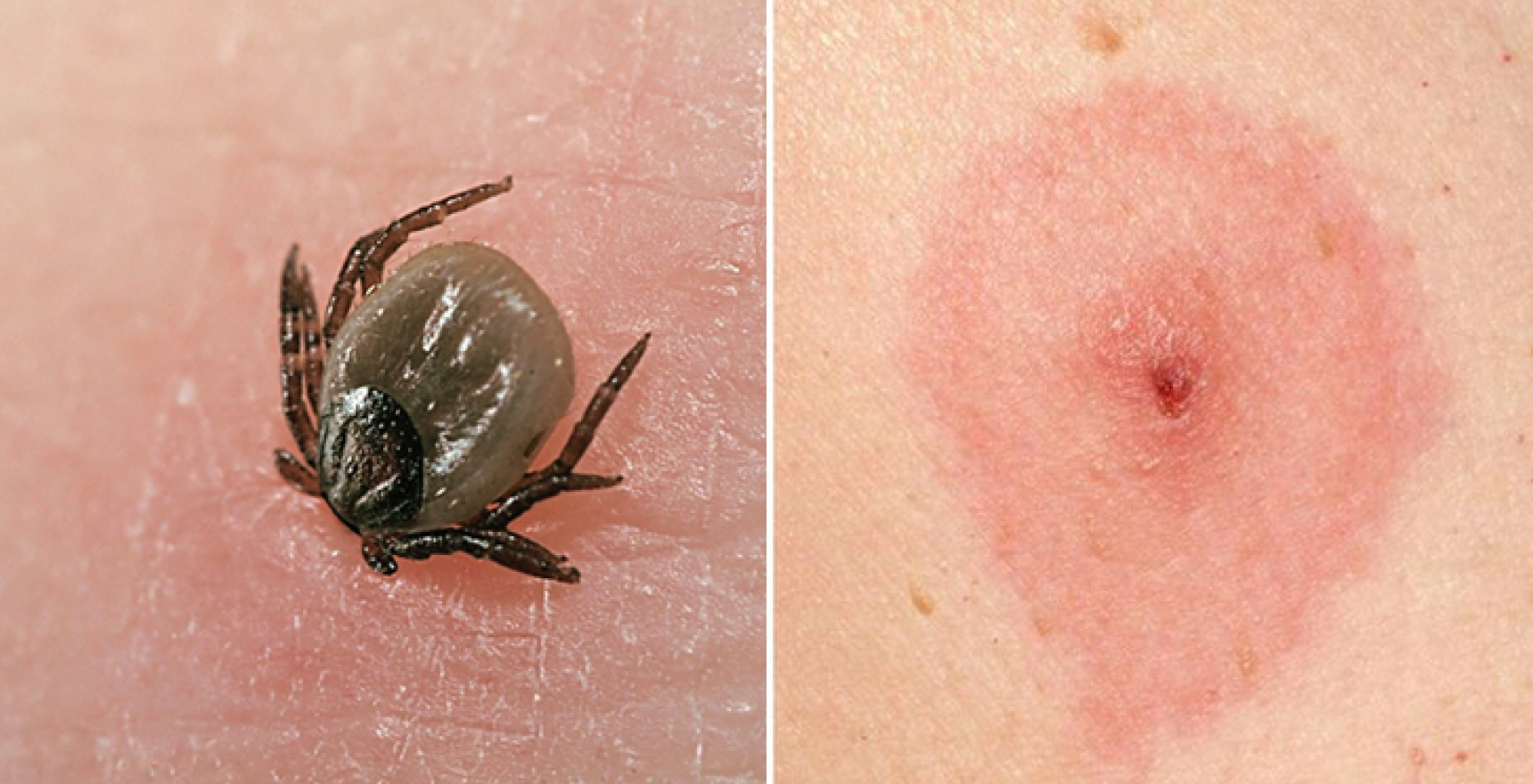 Фото - Переваги лабораторної діагностики Лайм- бореліозу (хвороби Лайма)